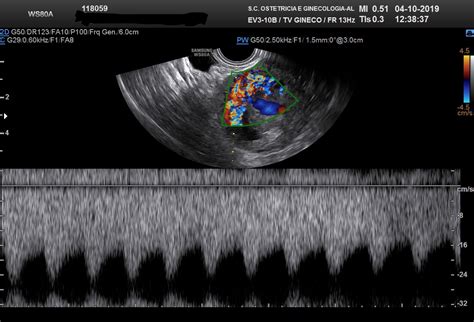 Uterine Arteriovenous Malformation After First Trimester Termination Of