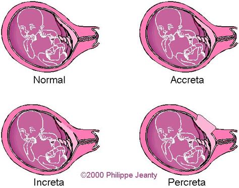 When The Placenta Attaches Invades Or Penetrates The Myometrium