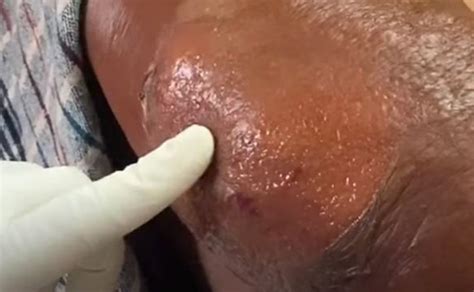 Incision And Drainage Of Arm Abscess New Pimple Popping Videos