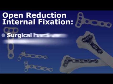 Open Reduction Internal Fixation