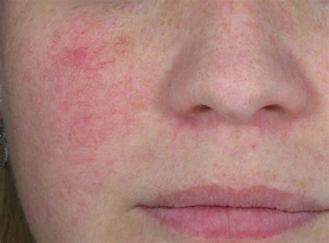 Types Of Rosacea Bumps And Pimples Rosacea Can Often Be C Flickr Photo Sharing