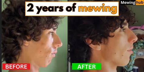 Mewing Before And After 2 Year Transformation Mewinghub