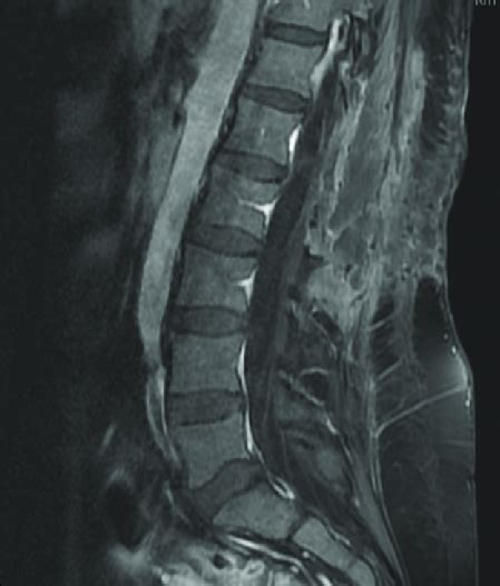 Post Operative Mri T1 Weighted Sagittal Lumbar Image With Gadolinium