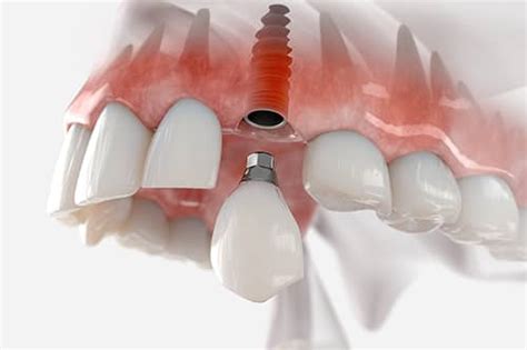 The Truth About Dental Implants Dental Implants Highlands Ranch