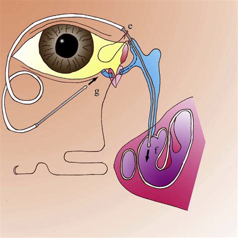 Complete The Bicanalicular Nasal Intubation With Silicone Tube