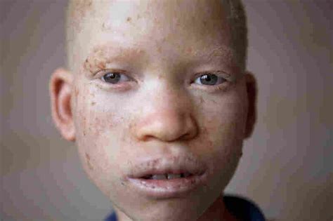 Portraits Of Albinism Letting An Inner Light Shine The Picture Show