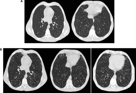 A) HRCT at 47 months after SSLTx. High-resolution computed tomography ...