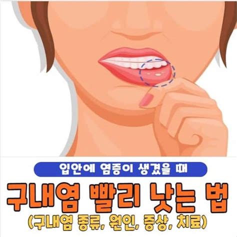 구내염 빨리 낫는 법 및 원인 치료 방법