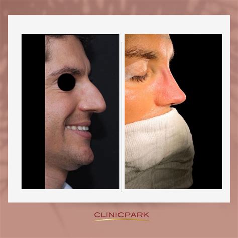 Nose Rhinoplasty Turkey Clinicpark