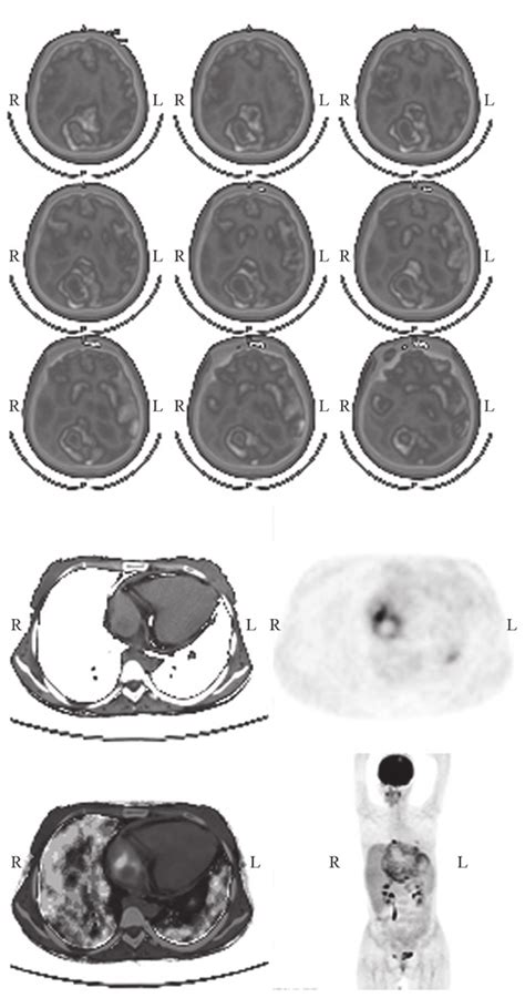 Positron Emission Tomography Pet Computed Tomography Ct Imaging Was