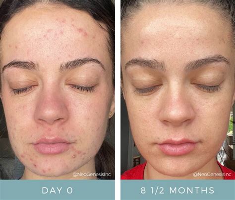 Amazing Results Of Neogenesis Microneedling For Acne Scarring