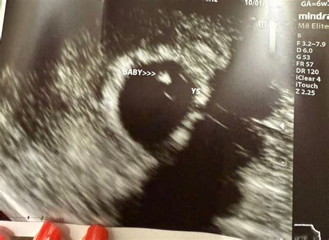 Early Glimpse Ultrasounds July Babies Forums What To Expect