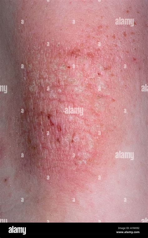 eczema skin rash Stock Photo: 3361425 - Alamy