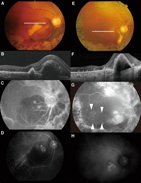 Retinal Findings Before A D And After E H Intravitreous Injection