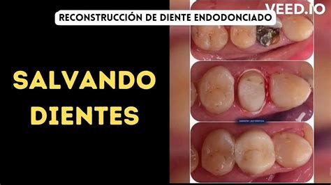 SALVANDO DIENTES Reconstrucción de Diente Endodonciado YouTube