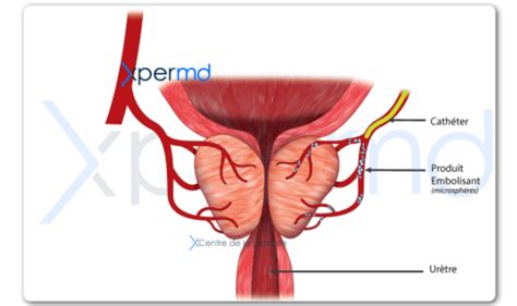 Embolisation De La Prostate Paris Xpermd