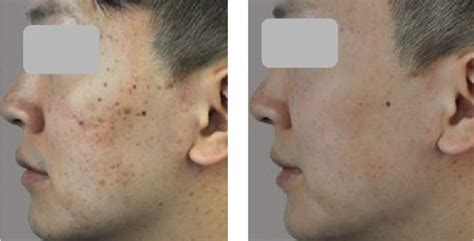 Dpc Laser Acne Treatments Vertex Aesthetics