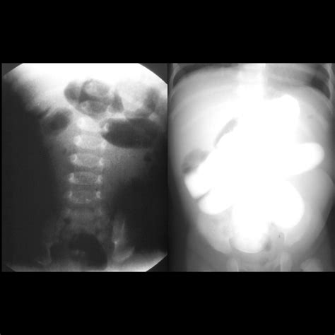 Pediatric Abdominal Adhesions Pediatric Radiology Reference Article Pediatric Imaging