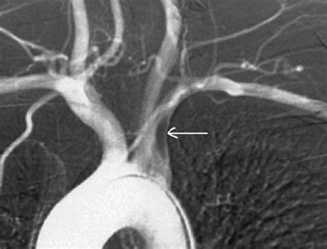 Subclavian Artery Thrombosis Statpearls Ncbi Bookshelf