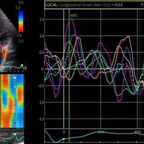 Measurement Of La Strain And Strain Rate In Apical Four Chamber View