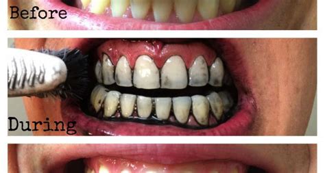 How does activated charcoal whiten teeth - Dr Chauvin