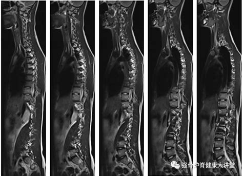 案例分享脊柱侧弯致自卑矫形术后挺脊梁 微医挂号网