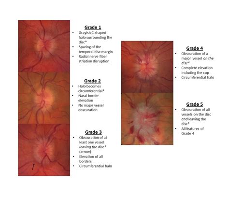 Normal Optic Nerve Vs Papilledema