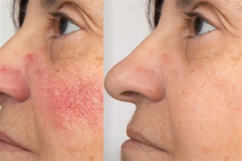 Best Treatment For Rosacea House Of Aesthetics London