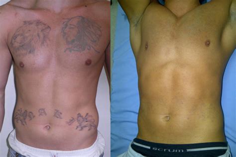 OUTattoo Eliminar Tatuajes Con Laser Cicatrices Y Manchas