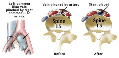 May-Thurner Syndrome - BEVSA - Buffalo Endovascular & Vascular Surgical ...