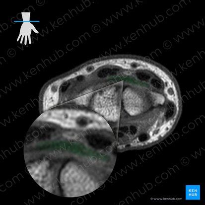 Wrist MRI: Interpretation, landmarks, anatomy | Kenhub