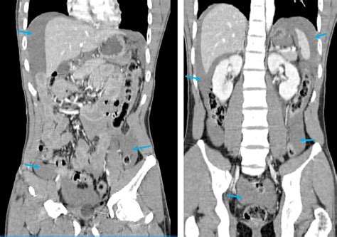 Blunt Trauma With Bowel And Mesenteric Injuries Radiology Cases