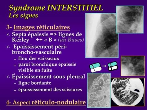 Ppt Radiologie Du Thorax Sémiologie Eia Pneumologie Pcem2 Partie 1