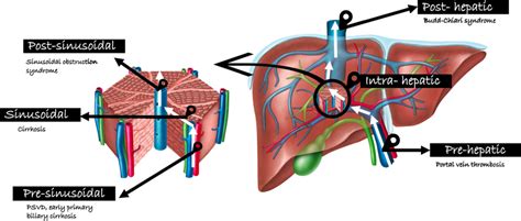 categories  common etiologies  portal hypertension  increase
