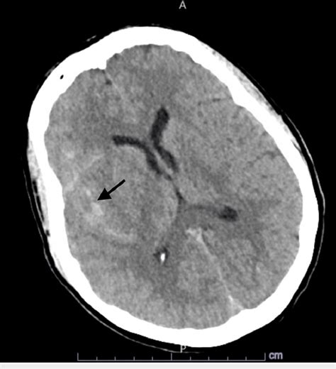 Parenchymal Extension Of Sah Computed Tomography Ct Head Showing Download Scientific Diagram