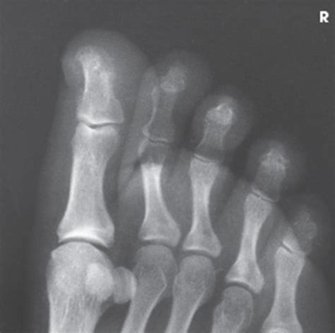 AP Oblique Projection Medial Rotation Diagram Quizlet