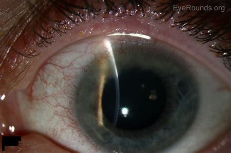 Corneal Marginal Ulcer