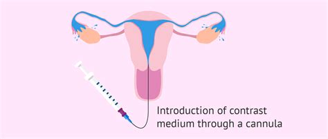 Hysterosalpingogram to detect Asherman