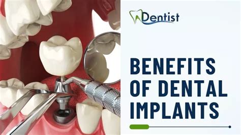 Ppt Benefits Of Dental Implants Powerpoint Presentation Free