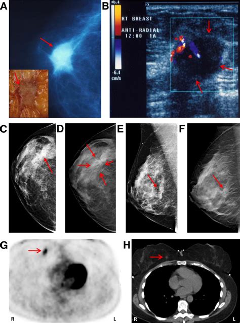 The Emerging Role Of The Molecular Diagnostics Laboratory In Breast Cancer Personalized Medicine