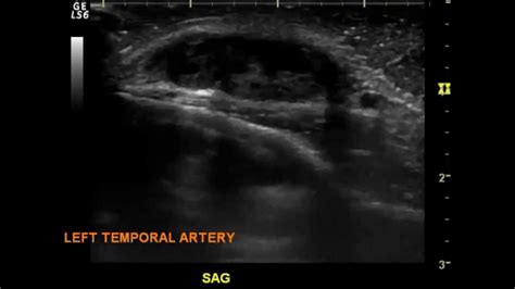 Temporal Artery Aneurysm