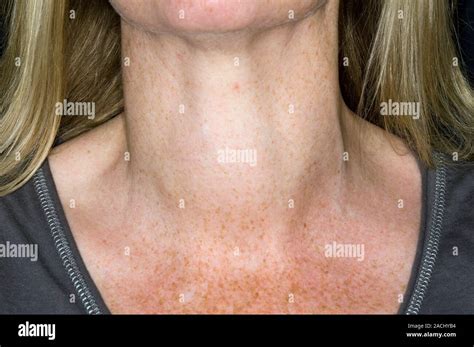 Swollen Neck In A 47 Year Old Female Patient With A Goitre This