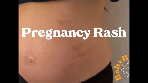 Pregnancy Rash Puppp Pg Heat Rash Youtube