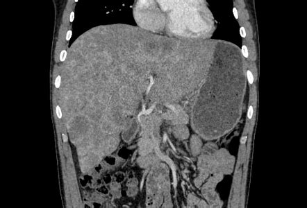 Hepatic Metastases From Gastric Cancer Image Radiopaedia Org