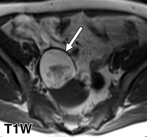 Characterization Of Genitourinary Lesions With Diffusion Weighted