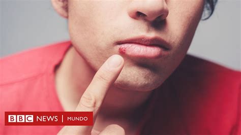 Contratista Demanda Zapatilla Herpes Labial Encias Inflamadas Expulsar