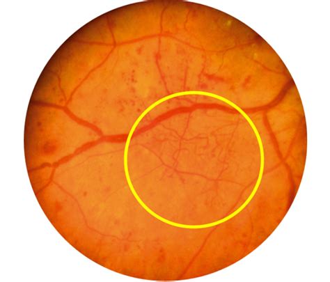 O que é retinopatia diabética Clínica Roisman