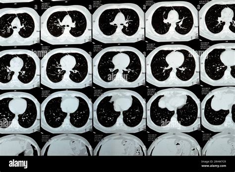 Multi slice CT scan of the chest showing normal study, normal ...