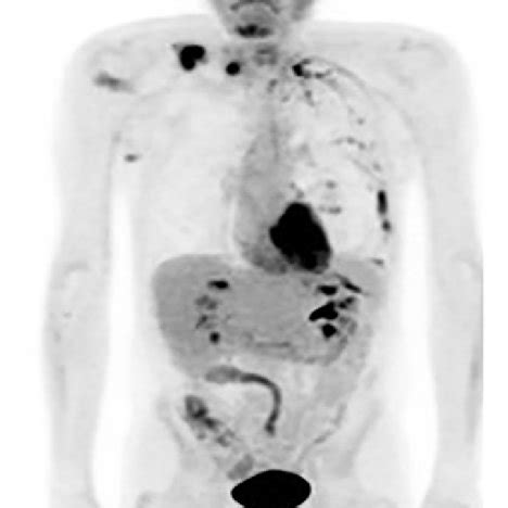 (a) PET scan at presentation, (b) PET scan done after 6 cycles of AVD ...