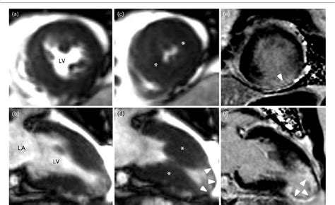 Figure 2 From Clinical Characteristics And Prognosis Of 60 Patients With Midventricular